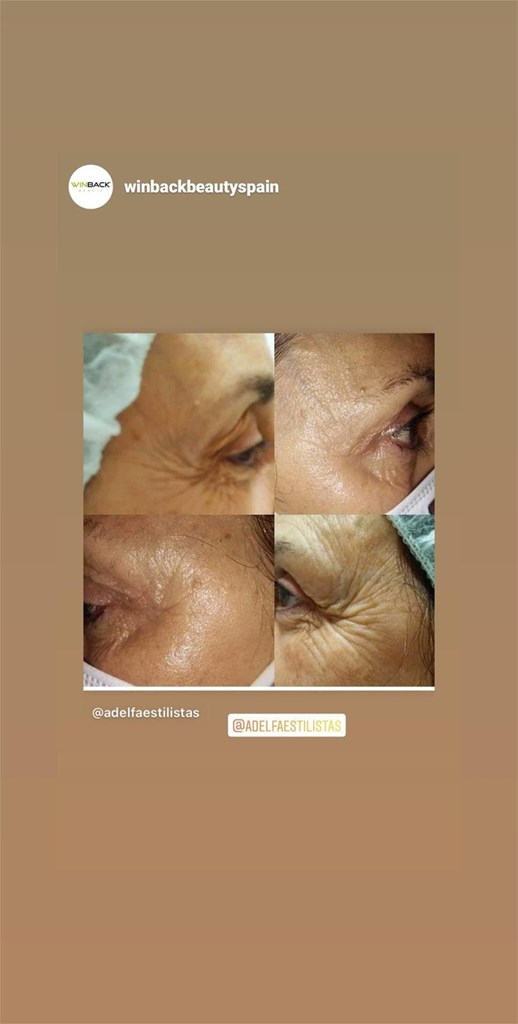 Foto 1 RADIOFRECUENCIA WIMBACK