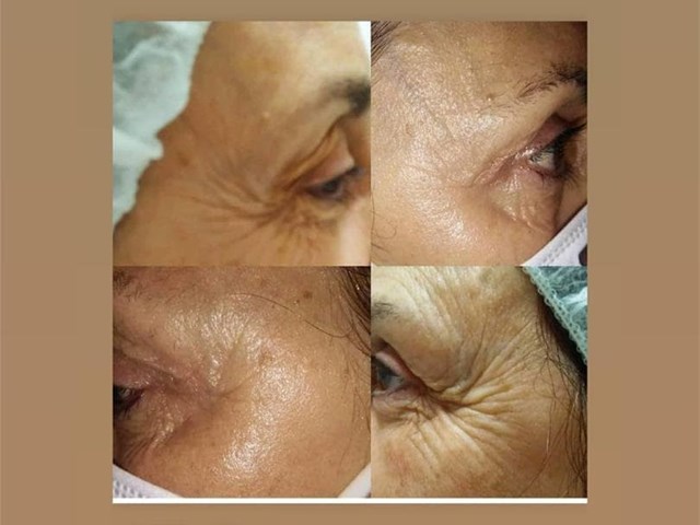 RADIOFRECUENCIA WIMBACK